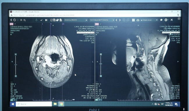 Specialists save a young person with a rare tumor from spinal cord damage and irreversible brain risk